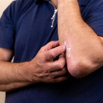 a worker suffering from skin dermatitis at work